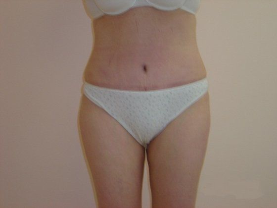 Liposuction Before And After Patient 8