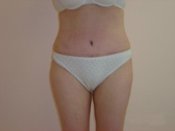 Liposuction Before And After Photo