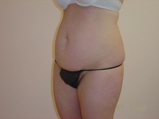 Liposuction Before And After Photo