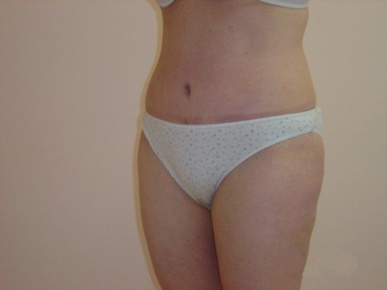 Liposuction Before And After Photo