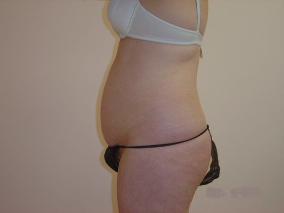 Liposuction Before And After Photo