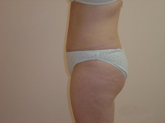 Liposuction Before And After Photo