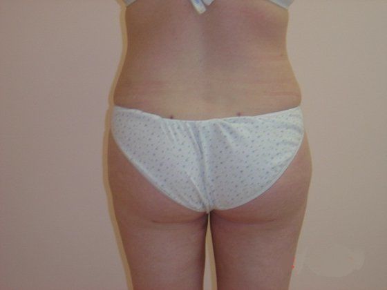 Liposuction Before And After Photo