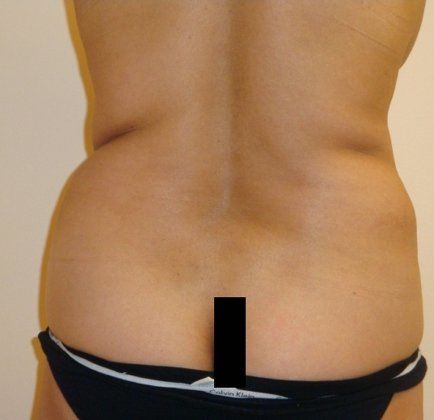 Liposuction Before And After Photo