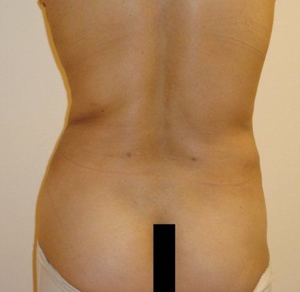 Liposuction Before And After Photo