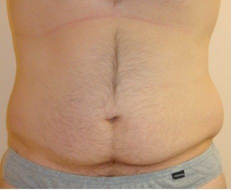 Liposuction Before And After Photo