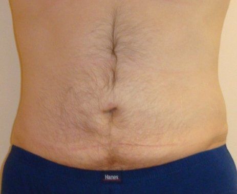 Liposuction Before And After Photo