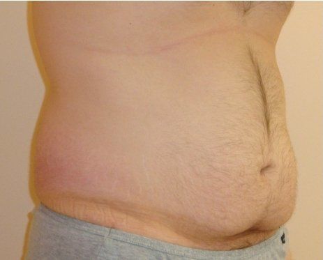 Liposuction Before And After Photo