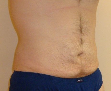 Liposuction Before And After Photo