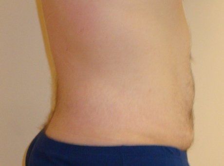 Liposuction Before And After Photo