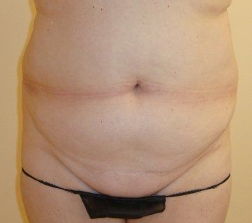 Liposuction Before And After Photo