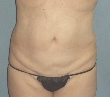 Liposuction Before And After Photo