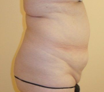 Liposuction Before And After Photo