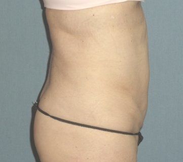 Liposuction Before And After Photo