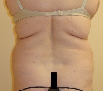 Liposuction Before And After Photo