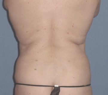 Liposuction Before And After Photo