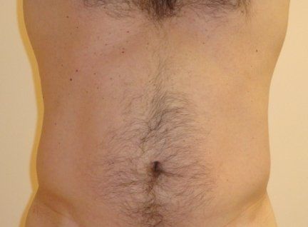 Liposuction Before And After Photo