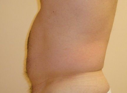 Liposuction Before And After Photo