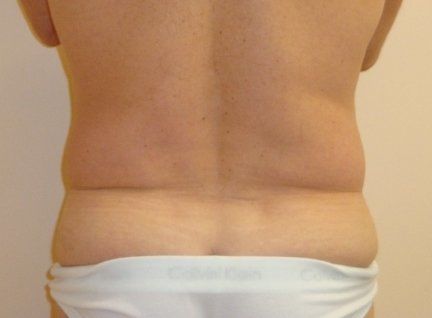 Liposuction Before And After Photo