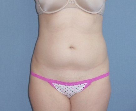 Liposuction Before And After Photo