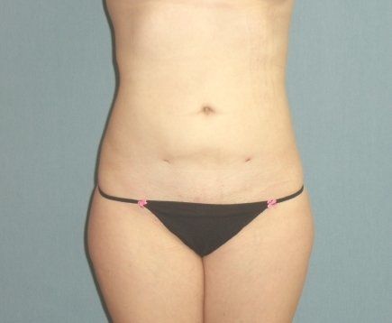 Liposuction Before And After Photo