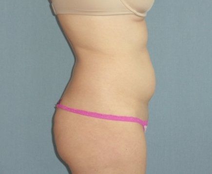 Liposuction Before And After Photo