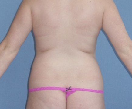 Liposuction Before And After Photo