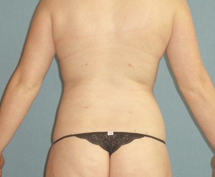 Liposuction Before And After Photo