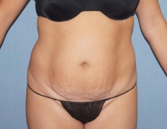 Liposuction Before And After Photo