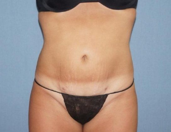 Liposuction Before And After Photo