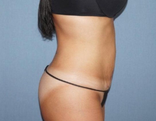 Liposuction Before And After Photo