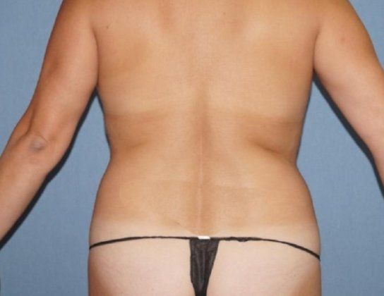 Liposuction Before And After Photo