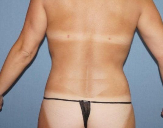 Liposuction Before And After Photo