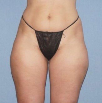 Liposuction Before And After Photo