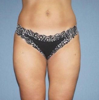 Liposuction Before And After Photo