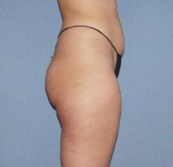 Liposuction Before And After Photo