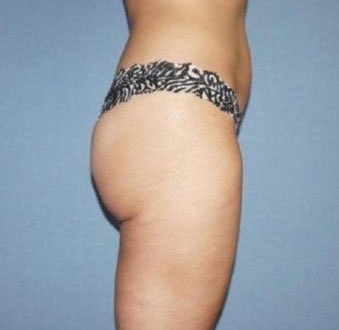 Liposuction Before And After Photo