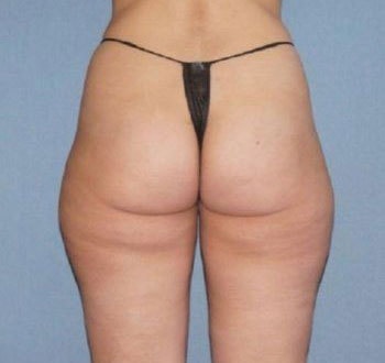 Liposuction Before And After Photo