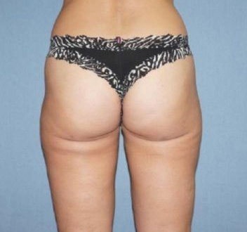 Liposuction Before And After Photo