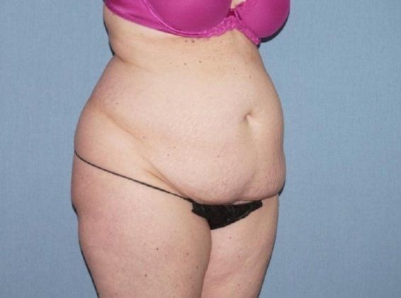 Liposuction Before And After Photo