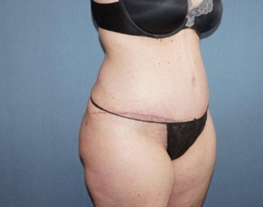 Liposuction Before And After Photo