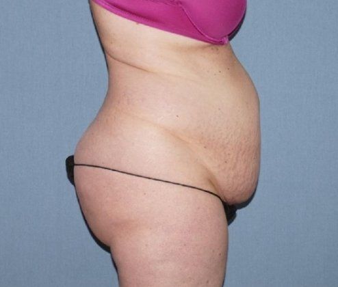 Liposuction Before And After Photo