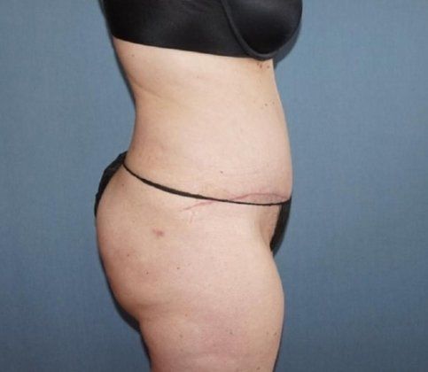 Liposuction Before And After Photo