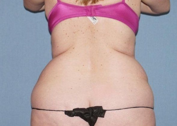 Liposuction Before And After Photo