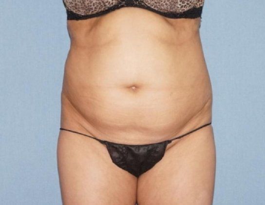Liposuction Before & After Image