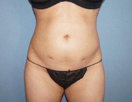 Liposuction Before And After Photo