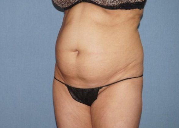 Liposuction Before And After Photo