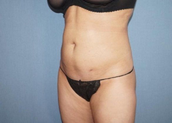 Liposuction Before And After Photo