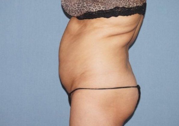 Liposuction Before And After Photo