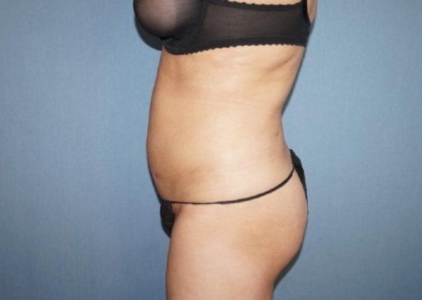 Liposuction Before And After Photo